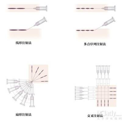 常用的注射方法有四种:线状注射法,多点序列注射法,扇形注射法和交叉